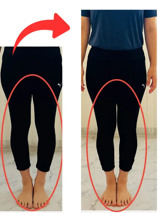 Sさん受講後　O脚改善